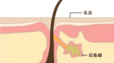 10羟基癸酸抗痘皮脂抑制