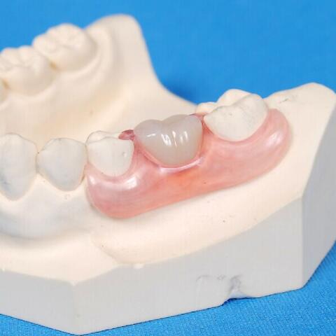 开云棋牌官网最新版
补牙材料 开云棋牌官网最新版
补牙材料